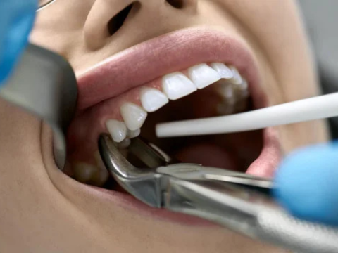 

Tooth Extractions


