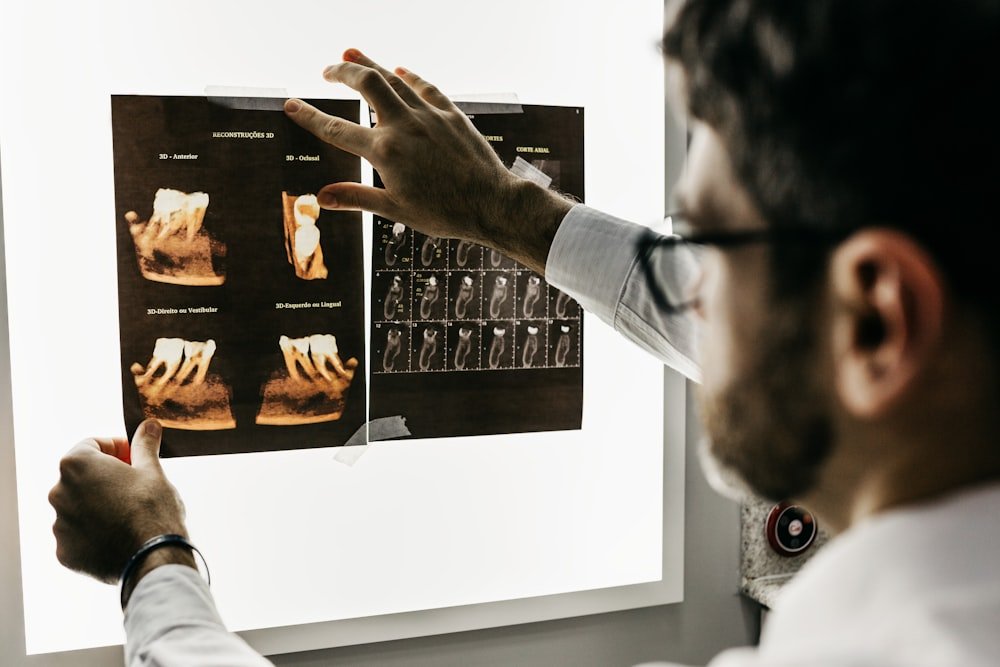 Apicoectomy Root End Surgery Comfort Smiles Noida
