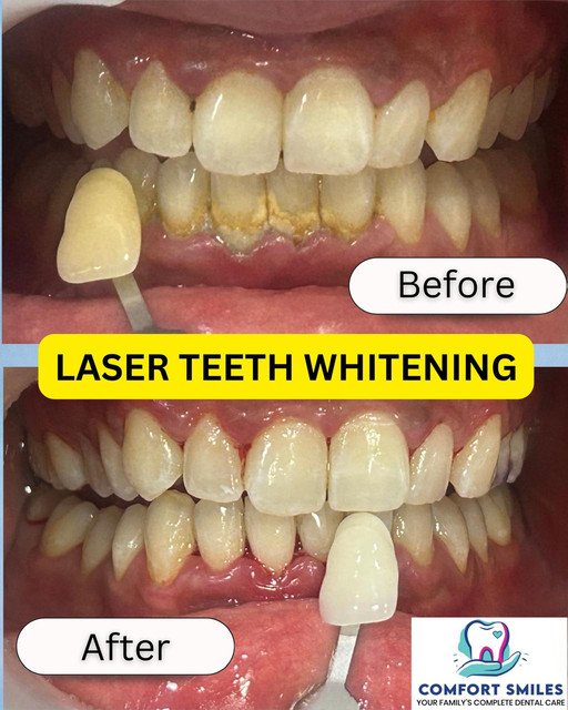 Emergency Dentist and Broken Tooth Treatment Noida