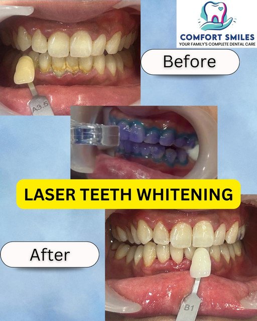 Invisalign and Clear Aligners at Comfort Smiles Noida