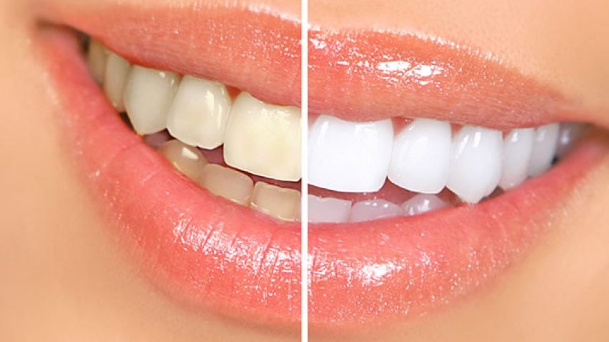 teeth-whitening201512